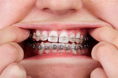 clear braces metal brackets|clear braces cost vs metal.